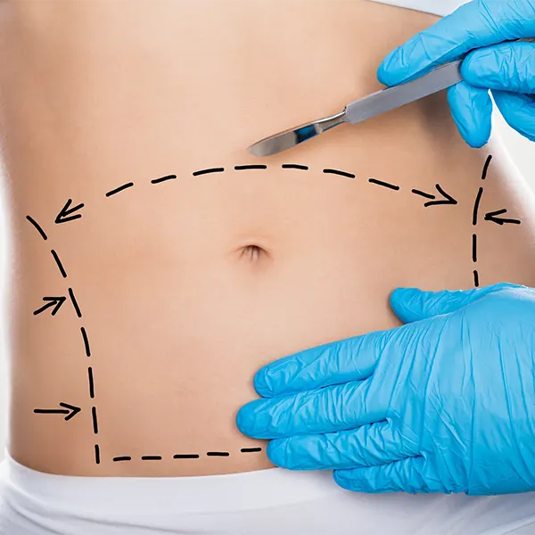Img-Dr_Mauricio_Serrano-CirugiaIndividual-2025-abdominoplastia-bogota