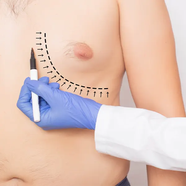 Img-Dr_Mauricio_Serrano-CirugiaIndividual-2025-ginecomastia-bogota