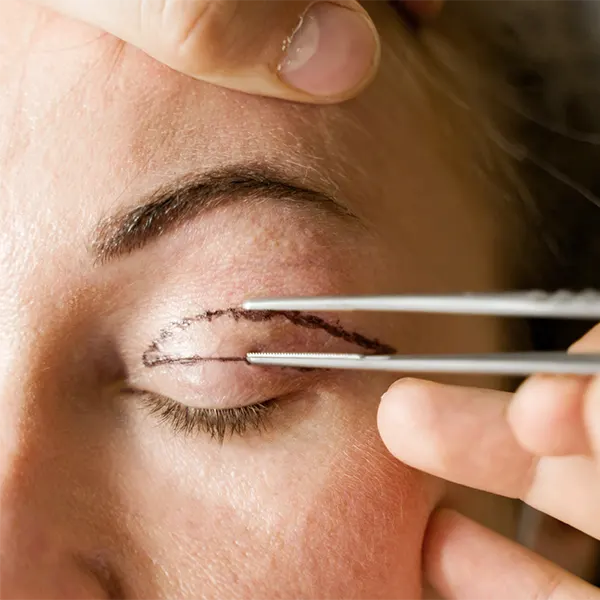 Img-blefaroplastia-bogota-2